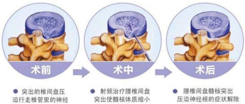 最新治疗腰椎间盘突出，突破传统，走向高效与精准